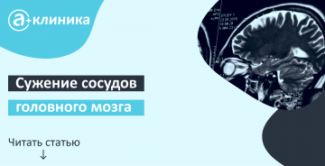 Сужение сосудов головного мозга