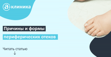 Причины и формы периферических отеков