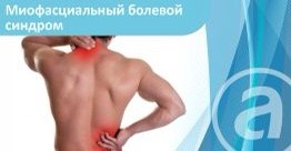 Миофасциальный болевой синдром